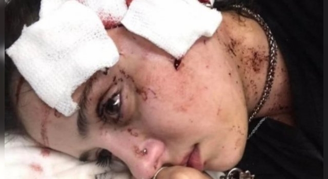 "Me arruinaron la cara": el drama de la camarera agredida por clientes en un bar de Mendoza