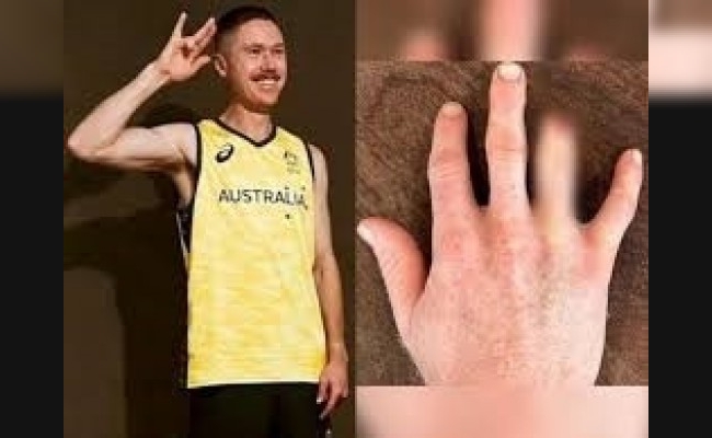 Un jugador de hockey australiano se amputó un dedo para participar en los JJOO